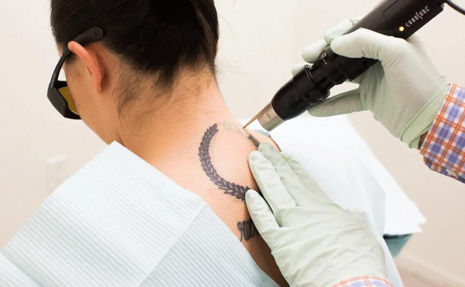 Is Tattoo Removal Effective?